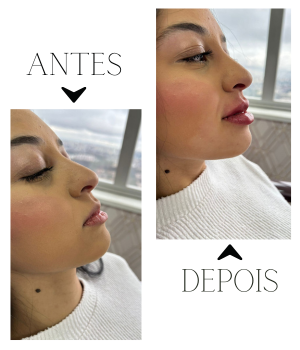 Preenchimento Labial
